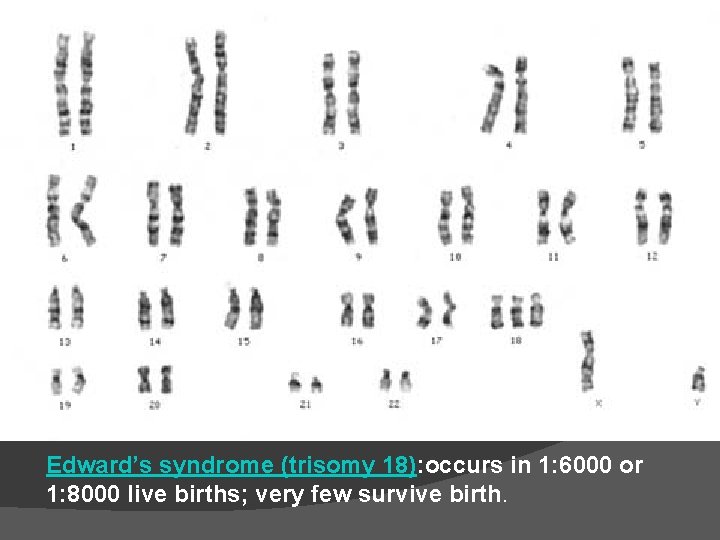 Edward’s syndrome (trisomy 18): occurs in 1: 6000 or 1: 8000 live births; very