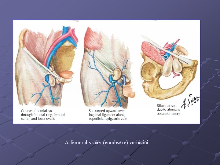 A femoralis sérv (combsérv) variációi 