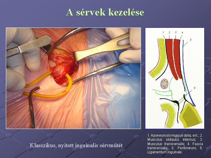 A sérvek kezelése Klasszikus, nyitott inguinalis sérvműtét 1. Aponeurosis musculi obliq. ext. ; 2.