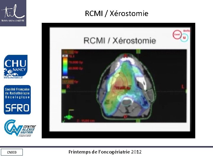 RCMI / Xérostomie CN 003 Printemps de l’oncogériatrie 2012 