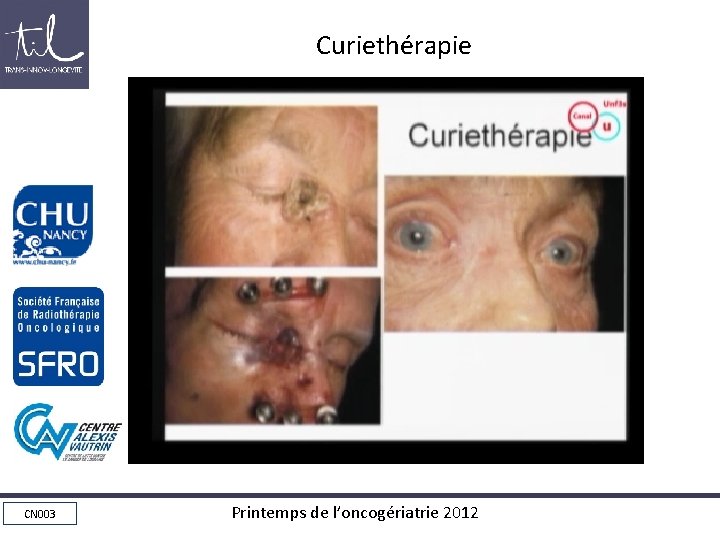 Curiethérapie CN 003 Printemps de l’oncogériatrie 2012 