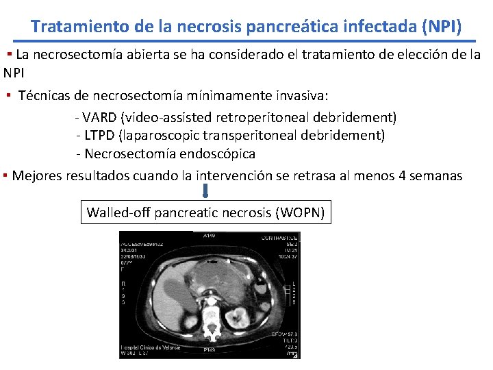 Tratamiento de la necrosis pancreática infectada (NPI) ▪ La necrosectomía abierta se ha considerado