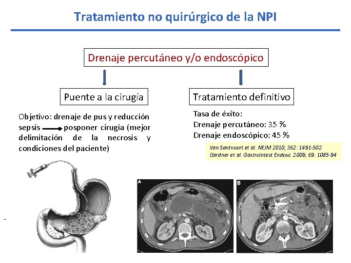 Tratamiento no quirúrgico de la NPI Drenaje percutáneo y/o endoscópico Puente a la cirugía