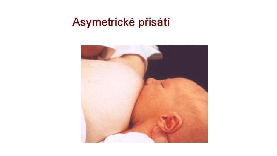 Asymetrické přisátí 