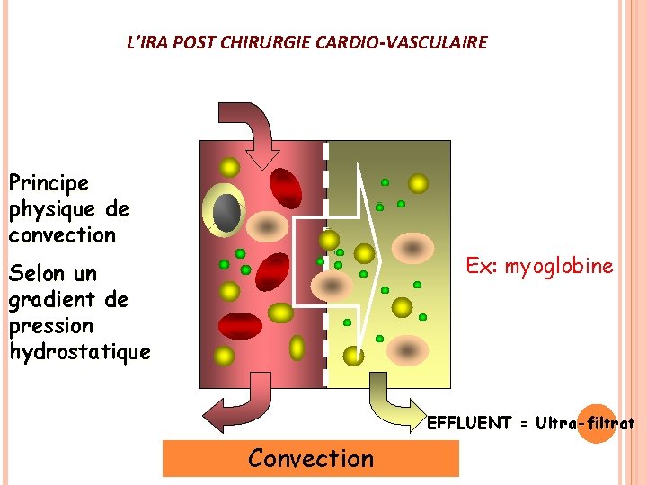L’IRA POST CHIRURGIE CARDIO-VASCULAIRE Elimination possible de molécules + grosses Ex: myoglobine Principe physique