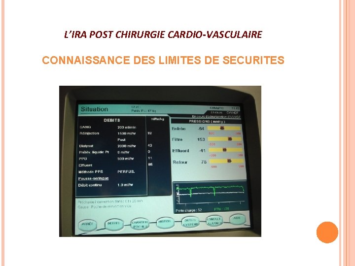 L’IRA POST CHIRURGIE CARDIO-VASCULAIRE CONNAISSANCE DES LIMITES DE SECURITES 