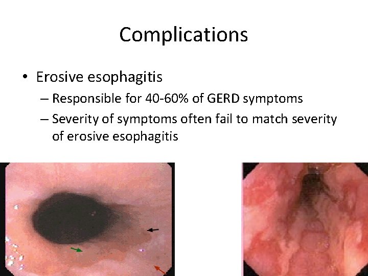 Complications • Erosive esophagitis – Responsible for 40 -60% of GERD symptoms – Severity