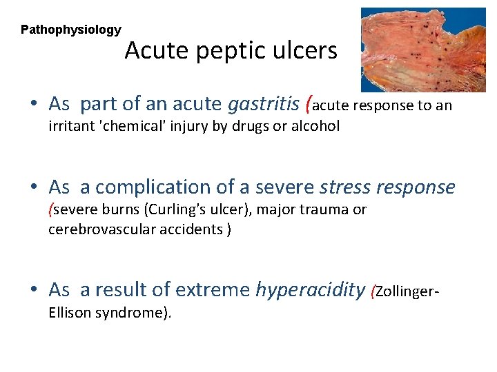 Pathophysiology Acute peptic ulcers • As part of an acute gastritis (acute response to