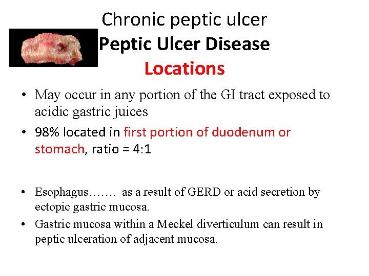 Chronic peptic ulcer Peptic Ulcer Disease Locations • May occur in any portion of