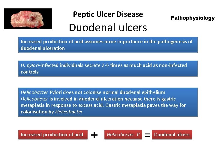 Peptic Ulcer Disease Duodenal ulcers Pathophysiology Increased production of acid assumes more importance in