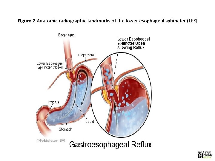 Figure 2 Anatomic radiographic landmarks of the lower esophageal sphincter (LES). 