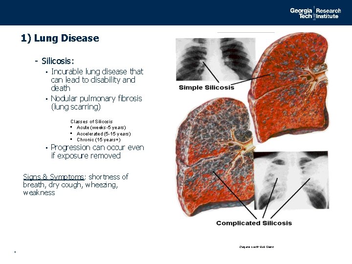 1) Lung Disease - Silicosis: • Incurable lung disease that can lead to disability