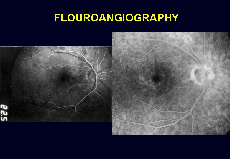 FLOUROANGIOGRAPHY 