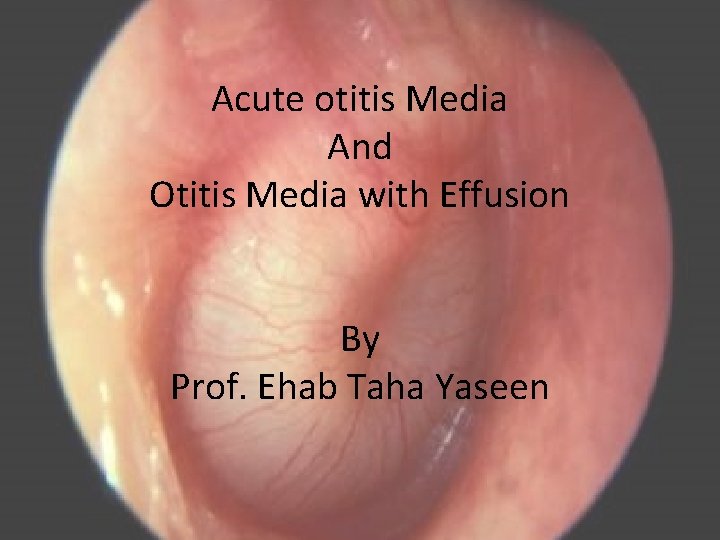 Acute otitis Media And Otitis Media with Effusion By Prof. Ehab Taha Yaseen 