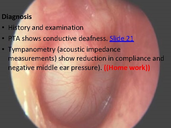 Diagnosis • History and examination • PTA shows conductive deafness. Slide 21 • Tympanometry