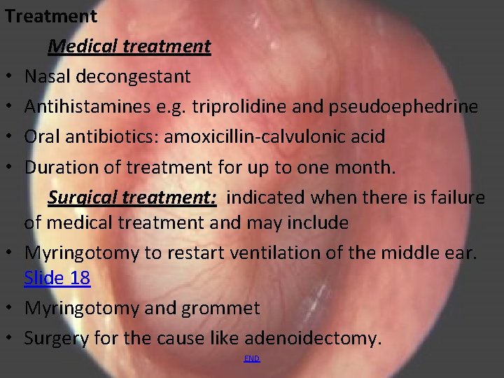 Treatment Medical treatment • Nasal decongestant • Antihistamines e. g. triprolidine and pseudoephedrine •