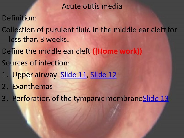 Acute otitis media Definition: Collection of purulent fluid in the middle ear cleft for