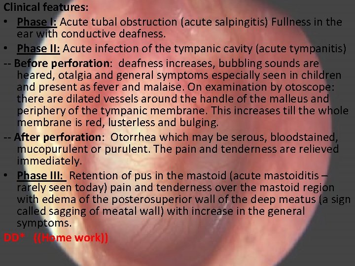 Clinical features: • Phase I: Acute tubal obstruction (acute salpingitis) Fullness in the ear