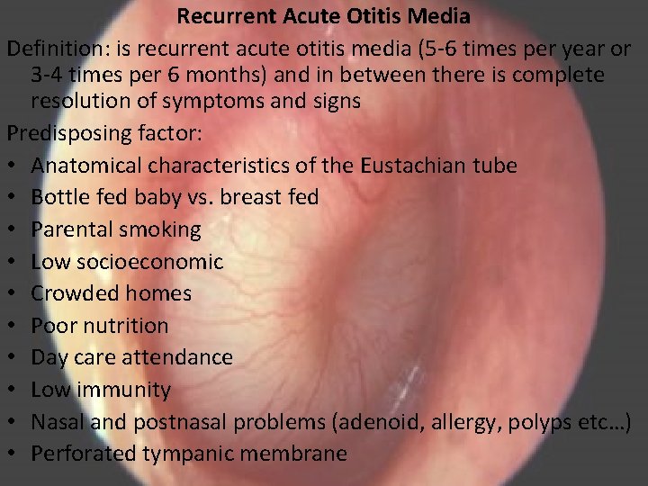 Recurrent Acute Otitis Media Definition: is recurrent acute otitis media (5 -6 times per