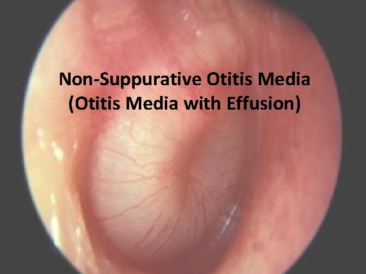 Non-Suppurative Otitis Media (Otitis Media with Effusion) 