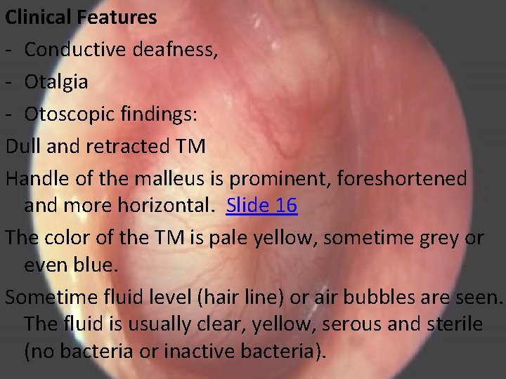 Clinical Features - Conductive deafness, - Otalgia - Otoscopic findings: Dull and retracted TM