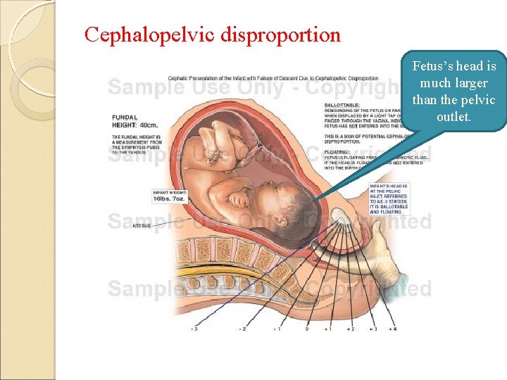 Cephalopelvic disproportion Fetus’s head is much larger than the pelvic outlet. 