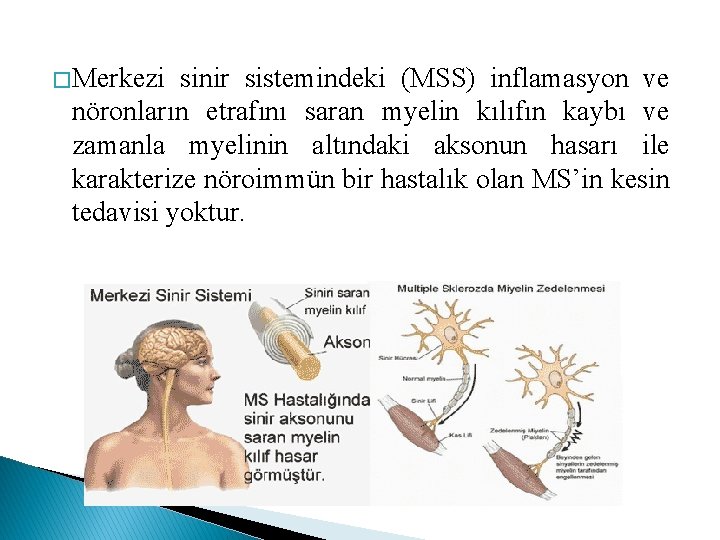 � Merkezi sinir sistemindeki (MSS) inflamasyon ve nöronların etrafını saran myelin kılıfın kaybı ve