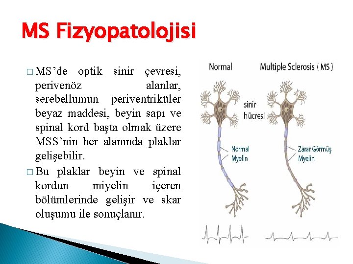 MS Fizyopatolojisi � MS’de optik sinir çevresi, perivenöz alanlar, serebellumun periventriküler beyaz maddesi, beyin