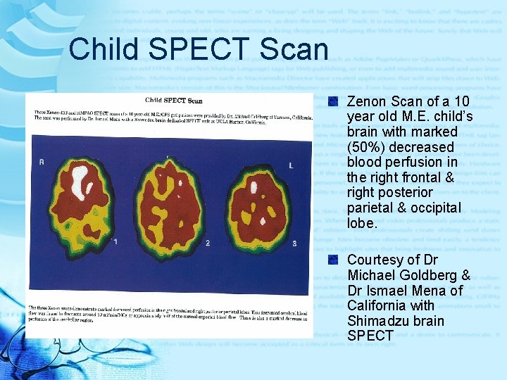 Child SPECT Scan Zenon Scan of a 10 year old M. E. child’s brain