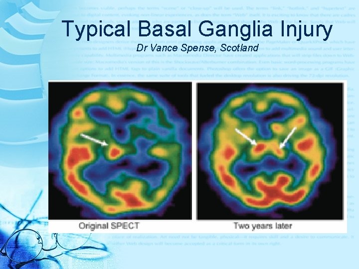 Typical Basal Ganglia Injury Dr Vance Spense, Scotland 