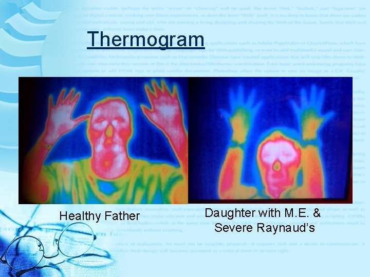Thermogram Healthy Father Daughter with M. E. & Severe Raynaud’s 