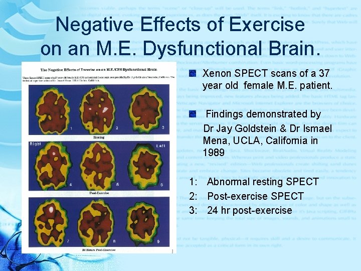 Negative Effects of Exercise on an M. E. Dysfunctional Brain. Xenon SPECT scans of