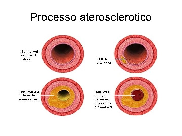 Processo aterosclerotico 