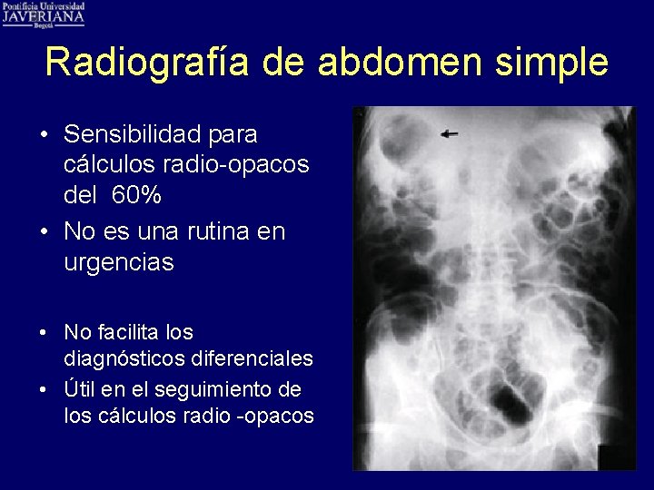 Radiografía de abdomen simple • Sensibilidad para cálculos radio-opacos del 60% • No es