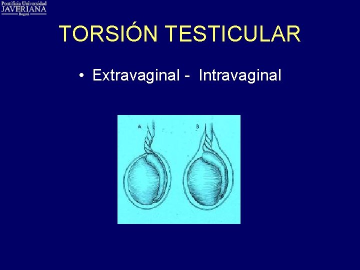 TORSIÓN TESTICULAR • Extravaginal - Intravaginal 