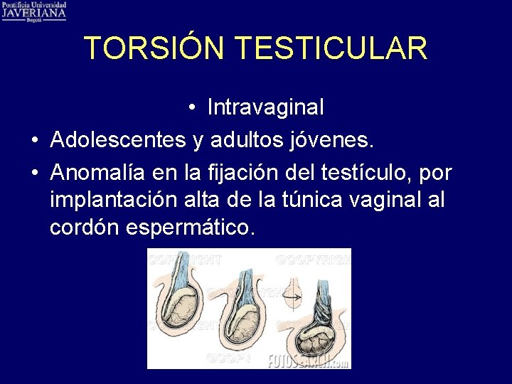 TORSIÓN TESTICULAR • Intravaginal • Adolescentes y adultos jóvenes. • Anomalía en la fijación