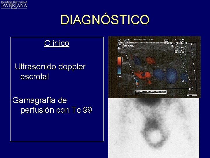 DIAGNÓSTICO Clínico Ultrasonido doppler escrotal Gamagrafía de perfusión con Tc 99 