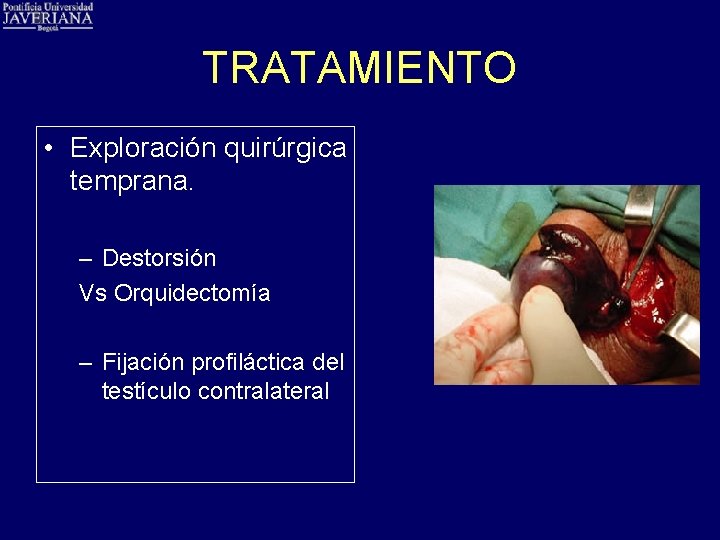 TRATAMIENTO • Exploración quirúrgica temprana. – Destorsión Vs Orquidectomía – Fijación profiláctica del testículo