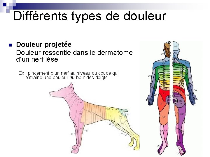 Différents types de douleur n Douleur projetée Douleur ressentie dans le dermatome d’un nerf