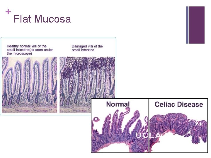 + Flat Mucosa 