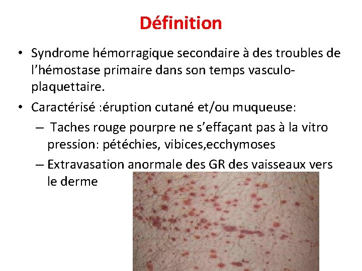 Définition • Syndrome hémorragique secondaire à des troubles de l’hémostase primaire dans son temps