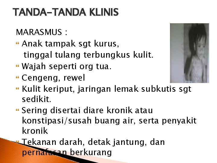 TANDA-TANDA KLINIS MARASMUS : Anak tampak sgt kurus, tinggal tulang terbungkus kulit. Wajah seperti