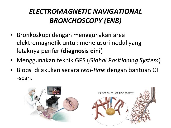 ELECTROMAGNETIC NAVIGATIONAL BRONCHOSCOPY (ENB) • Bronkoskopi dengan menggunakan area elektromagnetik untuk menelusuri nodul yang