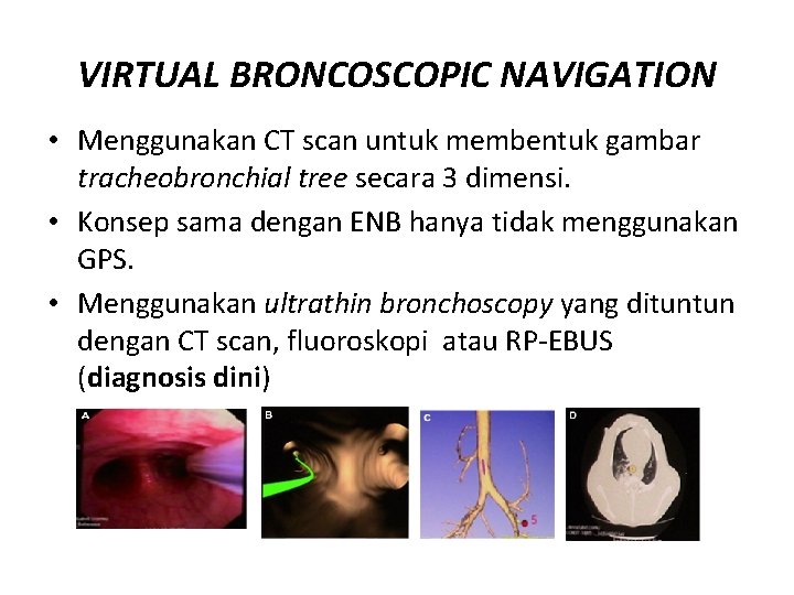 VIRTUAL BRONCOSCOPIC NAVIGATION • Menggunakan CT scan untuk membentuk gambar tracheobronchial tree secara 3