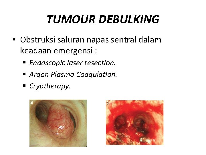 TUMOUR DEBULKING • Obstruksi saluran napas sentral dalam keadaan emergensi : § Endoscopic laser