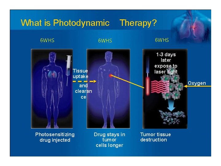 What is Photodynamic 6 WHS Therapy? 6 WHS 1 -3 days later expose to