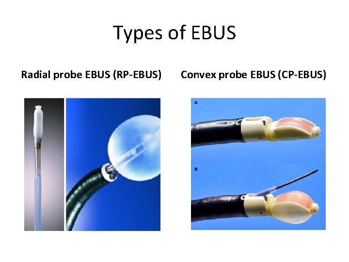 Types of EBUS Radial probe EBUS (RP-EBUS) Convex probe EBUS (CP-EBUS) 