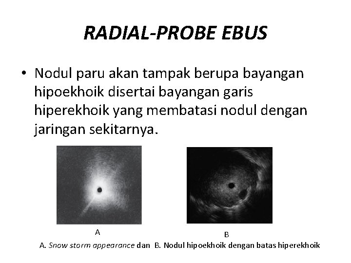 RADIAL-PROBE EBUS • Nodul paru akan tampak berupa bayangan hipoekhoik disertai bayangan garis hiperekhoik