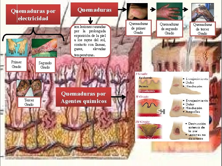 Quemaduras por electricidad Quemaduras son lesiones causadas por la prolongada exposición de la piel Quemaduras por electricidad Quemaduras son lesiones causadas por la prolongada exposición de la piel