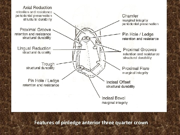 Features of pinledge anterior three quarter crown 